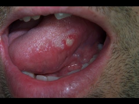 Na dapat gawin kapag ang kuko halamang-singaw YouTube folk remedyo paggamot ng kuko halamang-singaw