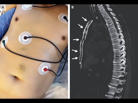 Instabiler Thorax