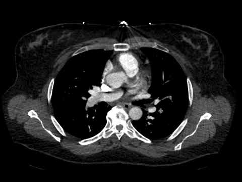 Saddle pulmonary embolism on CT