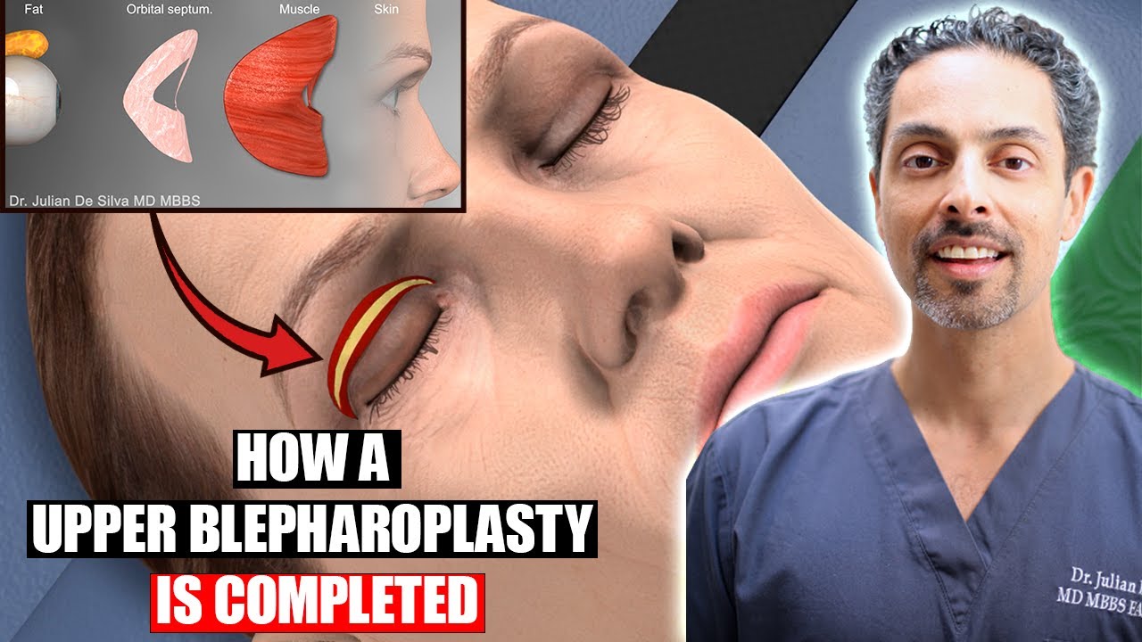 HOW A UPPER BLEPHAROPLASTY SURGERY IS COMPLETED - 3D ANIMATION