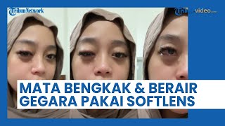 Ngaku Sakit dan Kapok, Mata Wanita Ini Jadi Bengkak dan Berair Gegara Pakai Softlens