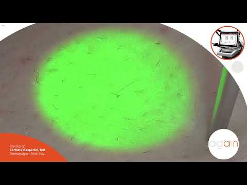 30 мм спот – Най-бързата александритна епилация с AGAIN | DEKA Bulgaria