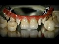 Why Do Sensitive Patients Always Prefer This Full-Mouth Implant Solution