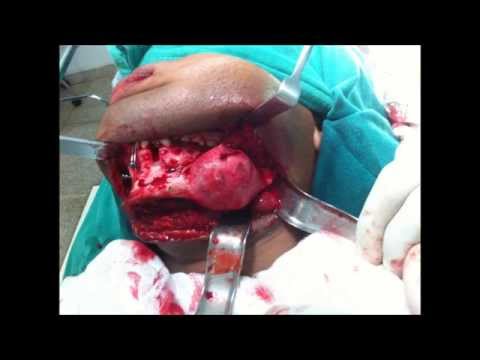 Ameloblastoma - Mandibulectomia parcial