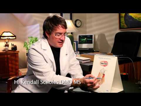 What are the different stages of Periodontal Disease?