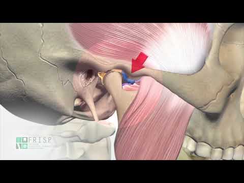 Osteocondrosi in neurologia ITU osteocondrosi