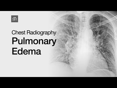 Chest Radiography: Pulmonary Edema