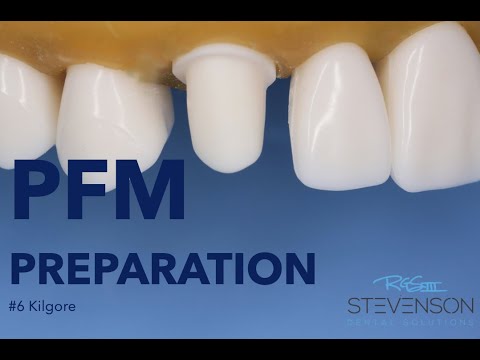 Preparacja zęba 13 pod koronę porcelanową na podbudowie metalowej