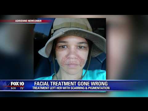 Fibroblast Treatment Gone Wrong