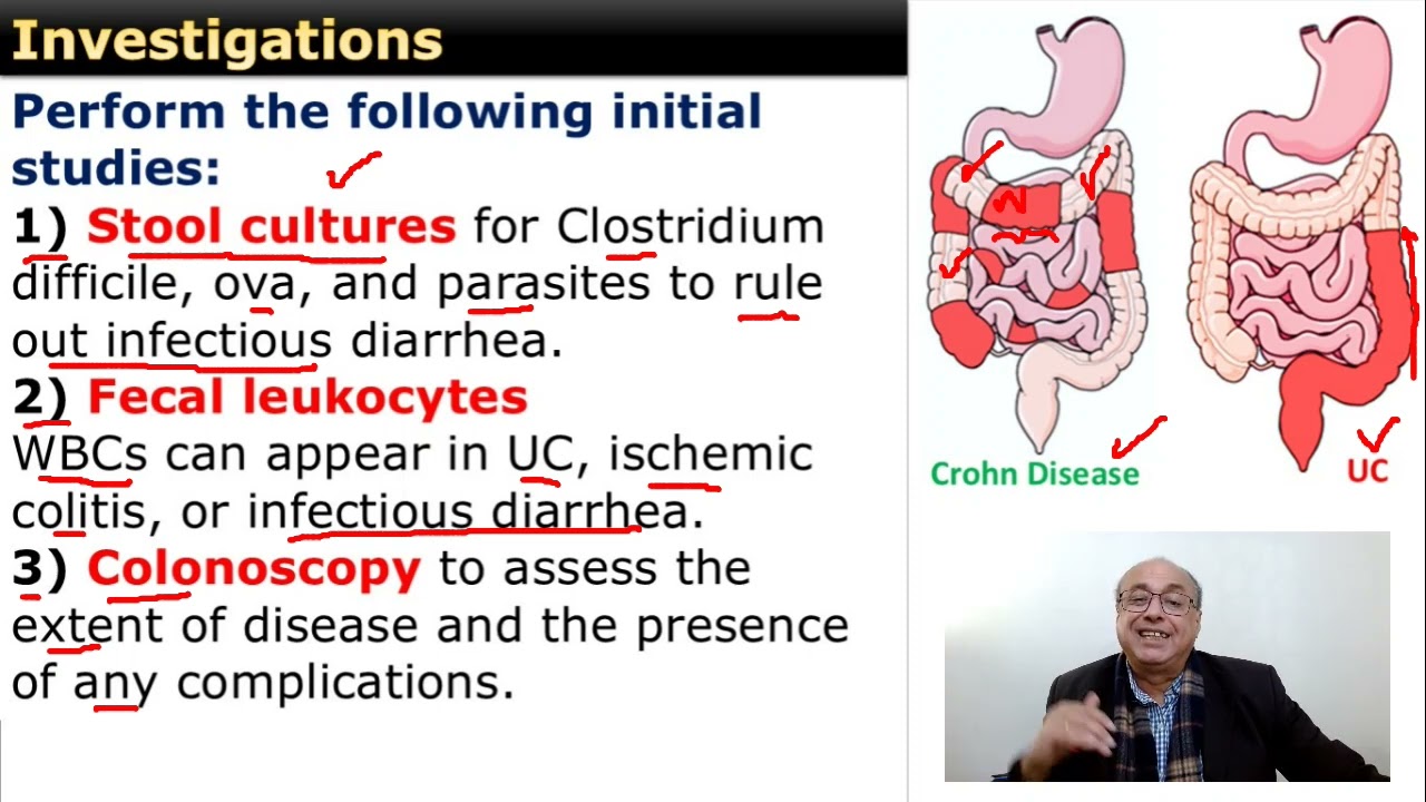 Ulcerative Colitis