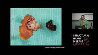 Resecting the Left Atrial Appendage During Cardiac Surgery – Dr Michael Vallely