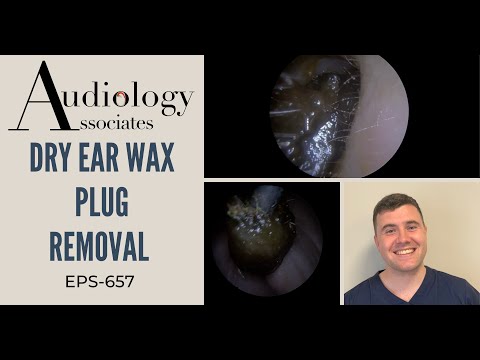 DRY EAR WAX PLUG REMOVAL - EP657