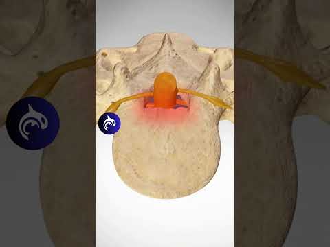 Lumbar Stenosis 3D Animation