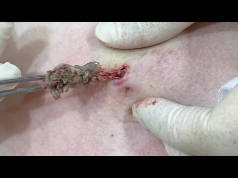 Large Epidermal Cyst on the Chest