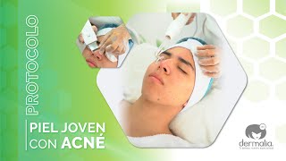 PROTOCOLO PARA PIEL JOVEN CON ACNÉ