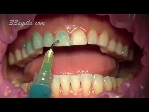 Prepless Veneers Permanent Teeth Whitening