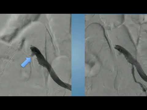 CVI 2019_Saturday, 7/20_ Master’s Approach to Critical Limb Ischemia III_Peter Monteleone, MD