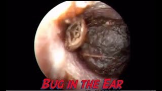 Wax and Bugs removed from Ear - USB OTOSCOPE