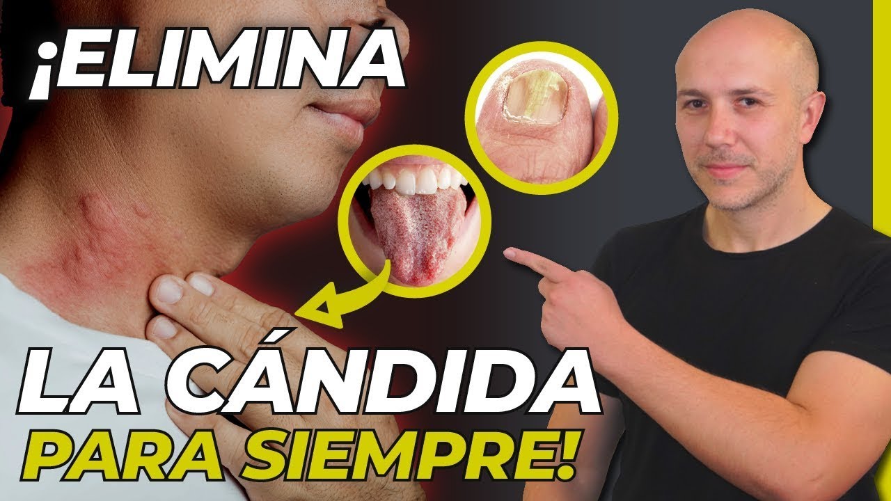 ¡ATENCIÓN! GUÍA COMPLETA PARA ENTENDER Y ELIMINAR LA CÁNDIDA DE TU CUERPO | SIGNOS DE CÁNDIDA