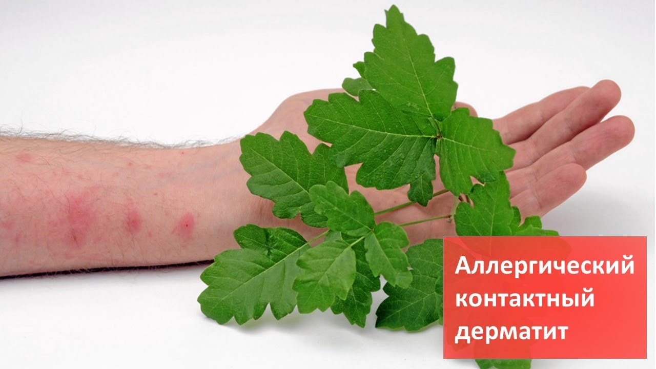 Аллергический контактный дерматит