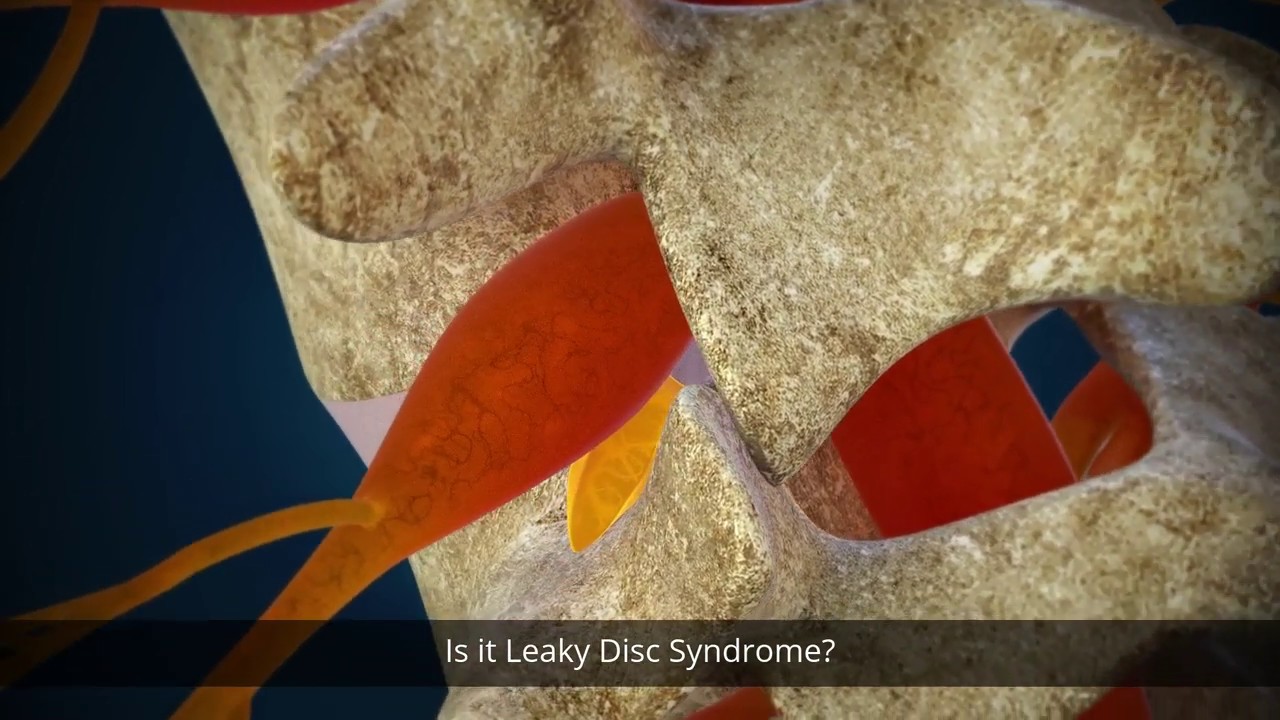 What Is The Discseel® Procedure? img