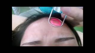 10600nm wavelength fractional CO2 laser, 100W high power scar removal, skin anti-aging.