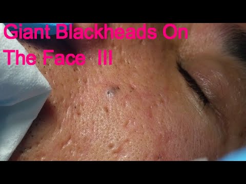 Huge Facials