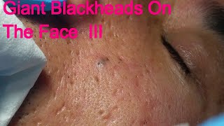 Giant Blackheads On The face  - Part III -