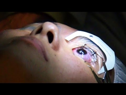 What It's Like To Get Laser Eye Surgery