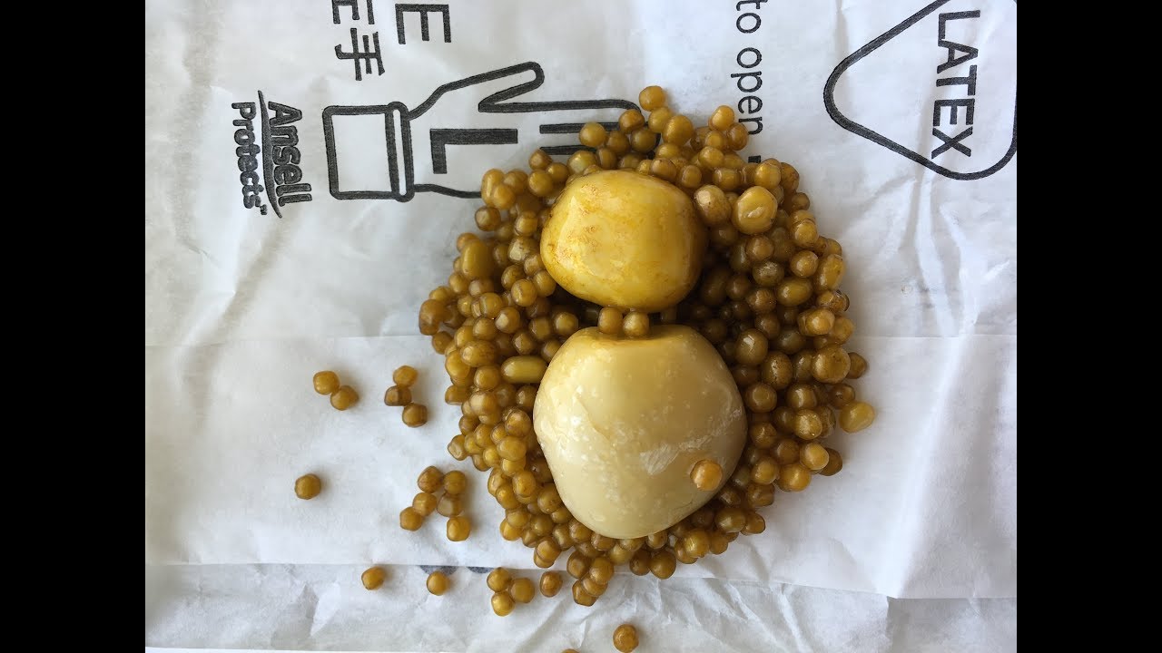 Опасный размер камней желчного пузыря