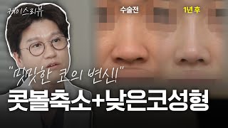밋밋한 콧대, 뭉뚝한 코끝, 넓은 콧볼을 세련되게! | 실리콘+비중격연골+콧볼축소 1년 경과 케이스리뷰