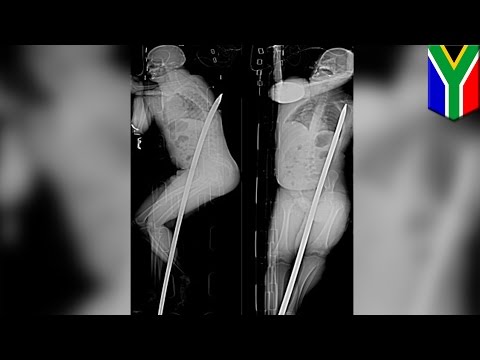 Impaled in butt: mine worker survives falling on 6-foot metal rod but loses kidney - TomoNews