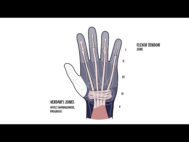 Flexor Tendon Injury & Anatomy Explained Zones, Anatomy, Diagnosis & Treatment