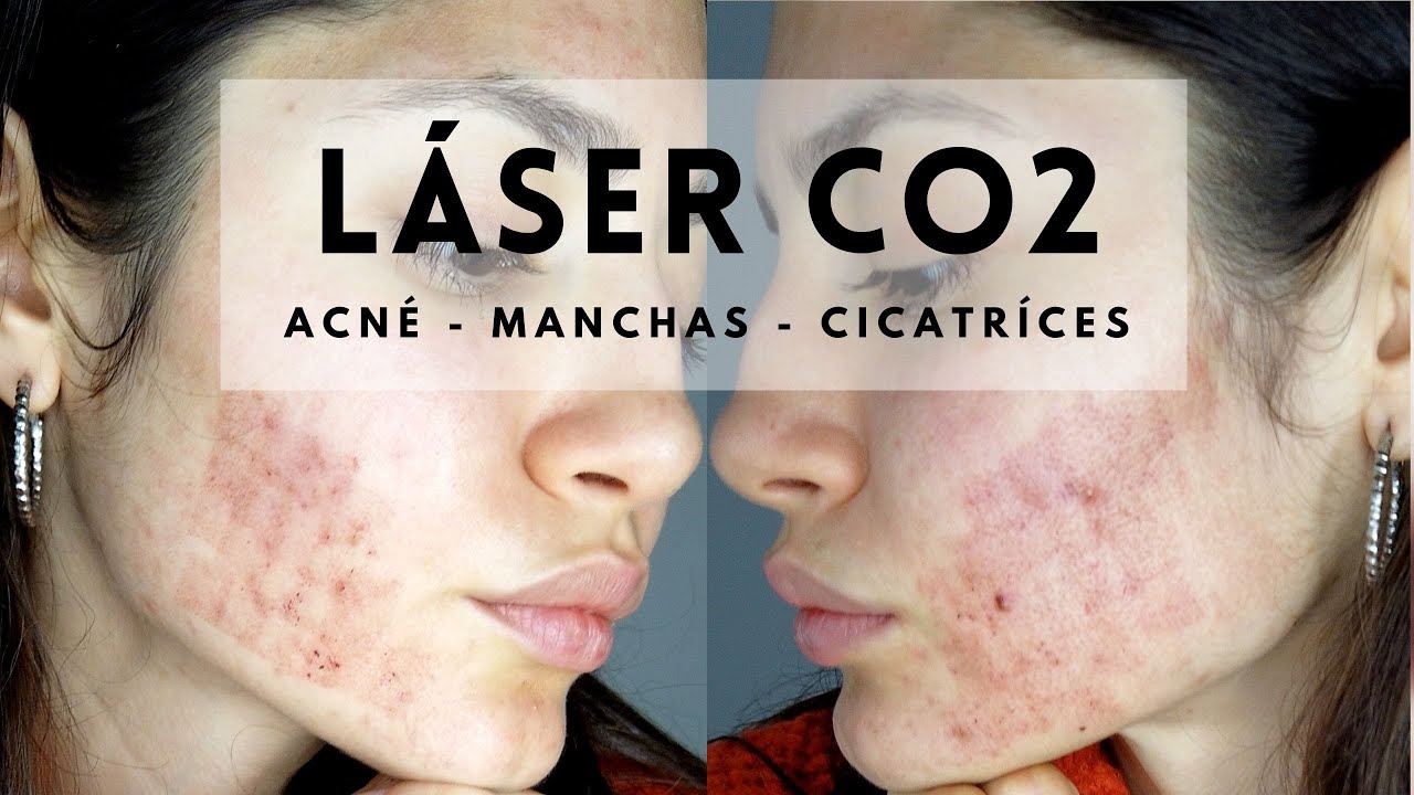 ACNÉ LASER CO2 Manchas y Cicatrices | Niki Mayo