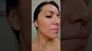 Using Bio-oil for my acne scars #biooil #acnescars #skincare #shorts