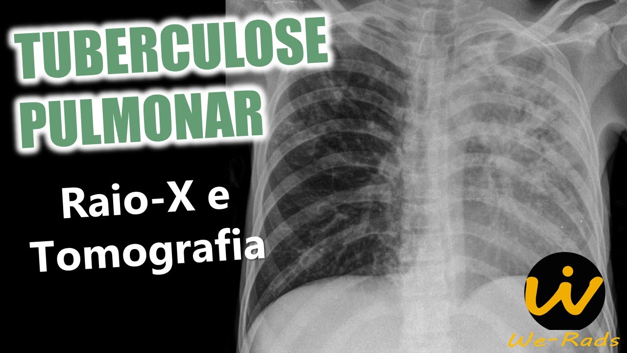 Tuberculose Pulmonar Clássica (disseminação endobrônquica e cavitação) - Raio X e Tomografia