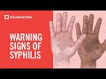 Warning Signs Of Syphilis