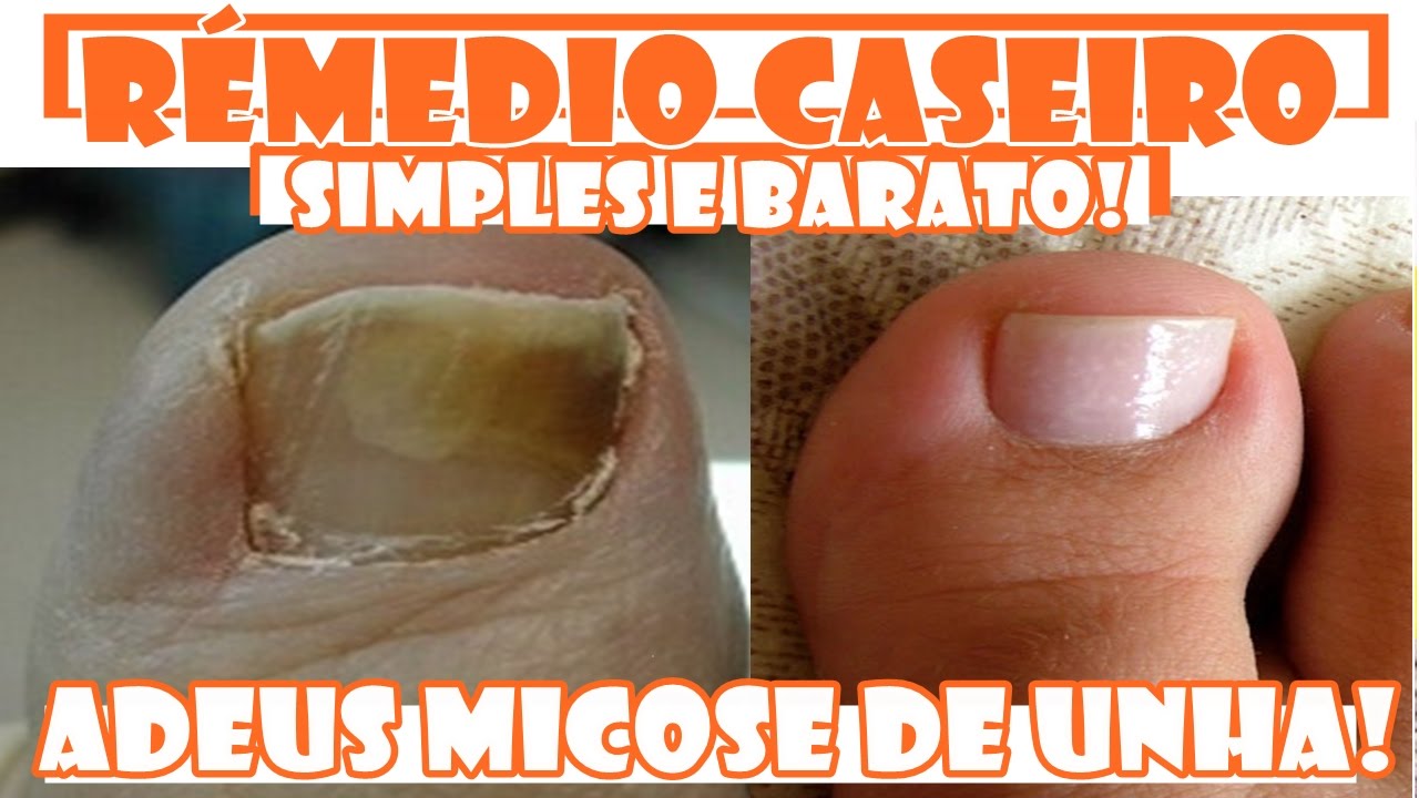 Incrível EXTERMINADOR DE FUNGOS DAS UNHAS!  Acabe de vez com a micose nas unhas! Fran Adorno