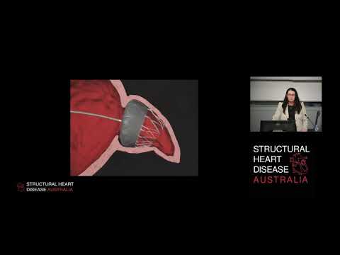 Procedural TOE Guidance for Left Atrial Appendage Occlusion - Dr Julie Humphries