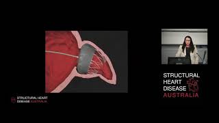 Procedural TOE Guidance for Left Atrial Appendage Occlusion – Dr Julie Humphries