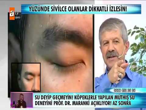 yuz paraziti maranki scapă de papilomas