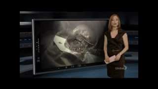 LASIK risks, complications, and side effects - Global TV 16x9 - 2/9/2013