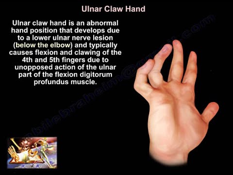 Claw Hand  and Ulnar Claw Hand  - Everything You Need To Know - Dr. Nabil Ebraheim