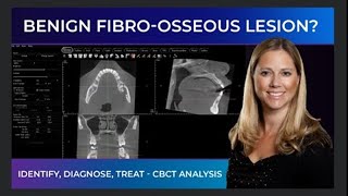 Interpreting a Benign Fibro-Osseous Lesion with CBCT | Case Bites