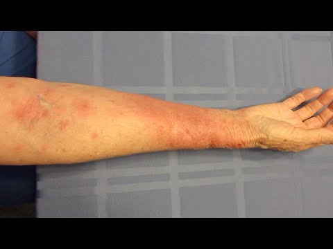 image-What does poison sumac look like on human skin?