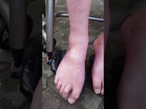 Deformacje Varus stóp Toe narośl zdjęcie