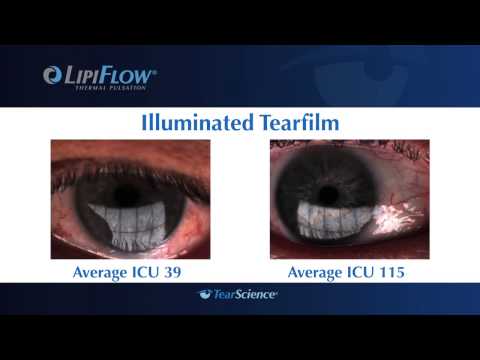 Lipiflow and Lipiview