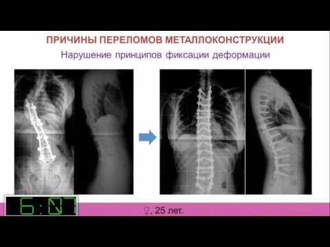 Боль в области шеи и затылка при повороте головы Болит поясница при упражнениях на пресс