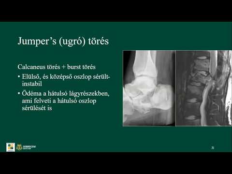 kezelhető-e a visszér piócákkal