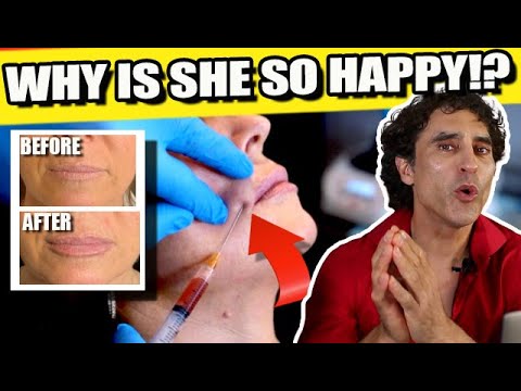 100% Natural Lip No Filler !! PRF Platelet Rich Fibrin Technique